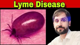 Lyme Disease | Lyme Disease in Humans | MLT Hub with kamran