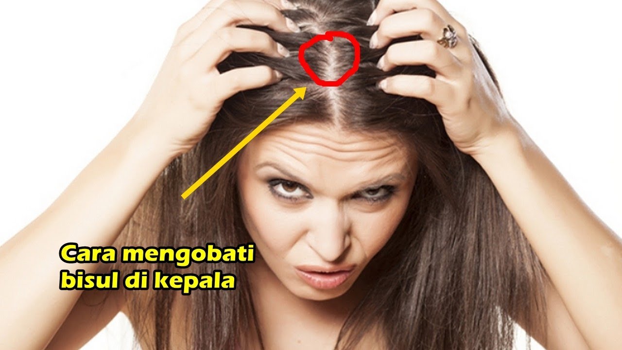 Bisul di Kulit Kepala, Ini Penyebab dan Cara Mengobatinya