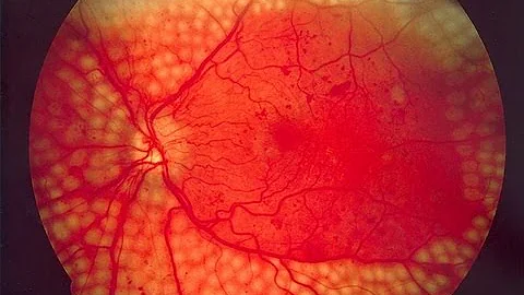 How diabetes affects the eyes - Dr Haresh Asnani