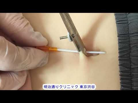 ボディピアスの開け方 へそ 14Gニードル 14Gピアス