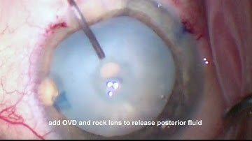Prevention of Argentinian flag sign with phaco rhexis for dense white cataract with miLoop