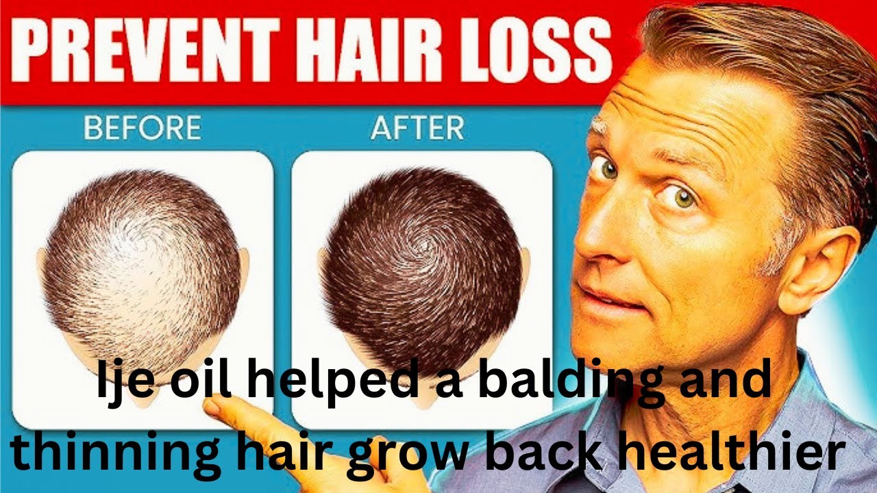 How Ije oil helped a balding and thinning hair grow back healthier and