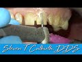 Prepping Maxillary Teeth for Veneers - Dental Minute with Steven T. Cutbirth, DDS
