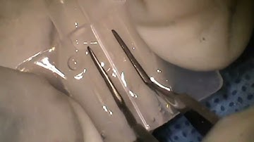 How to load hydrophilic foldable IOL ?