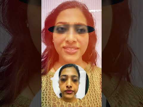 Facelift Transformation Facebook Threads Threads Facialtreatment Transformation Antiaging