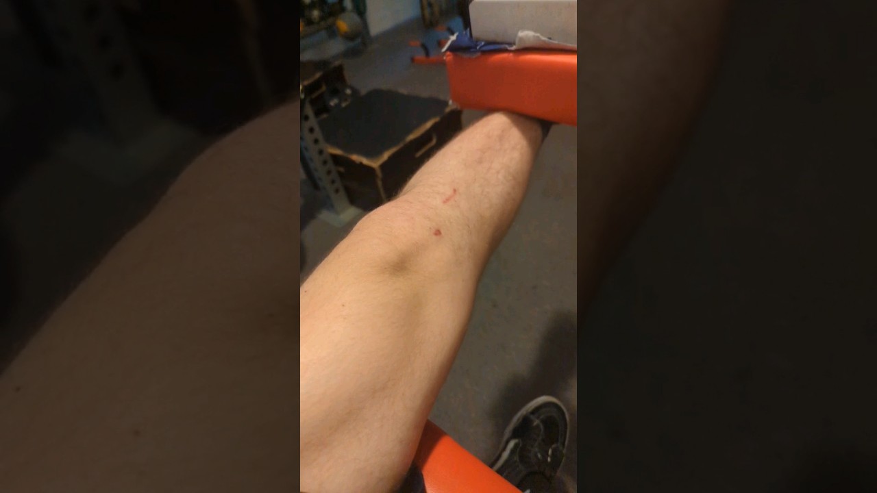ACL Reconstruction Recovery Day 66 YouTube