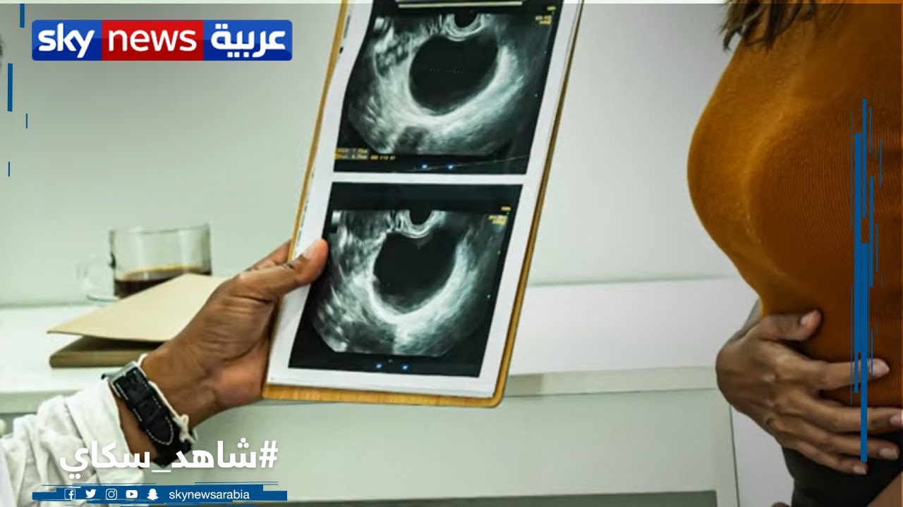 تشخيص| زيادة شعر الوجه والجسم عند المرأة وعلاقته بتكيس المبايض؟