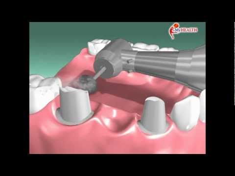 Video: Jambatan Pergigian: 4 Jenis, Faedah, Kes Penggunaan Dan Kos