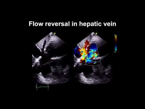 Video: Este valva pulmonară tricuspidă?