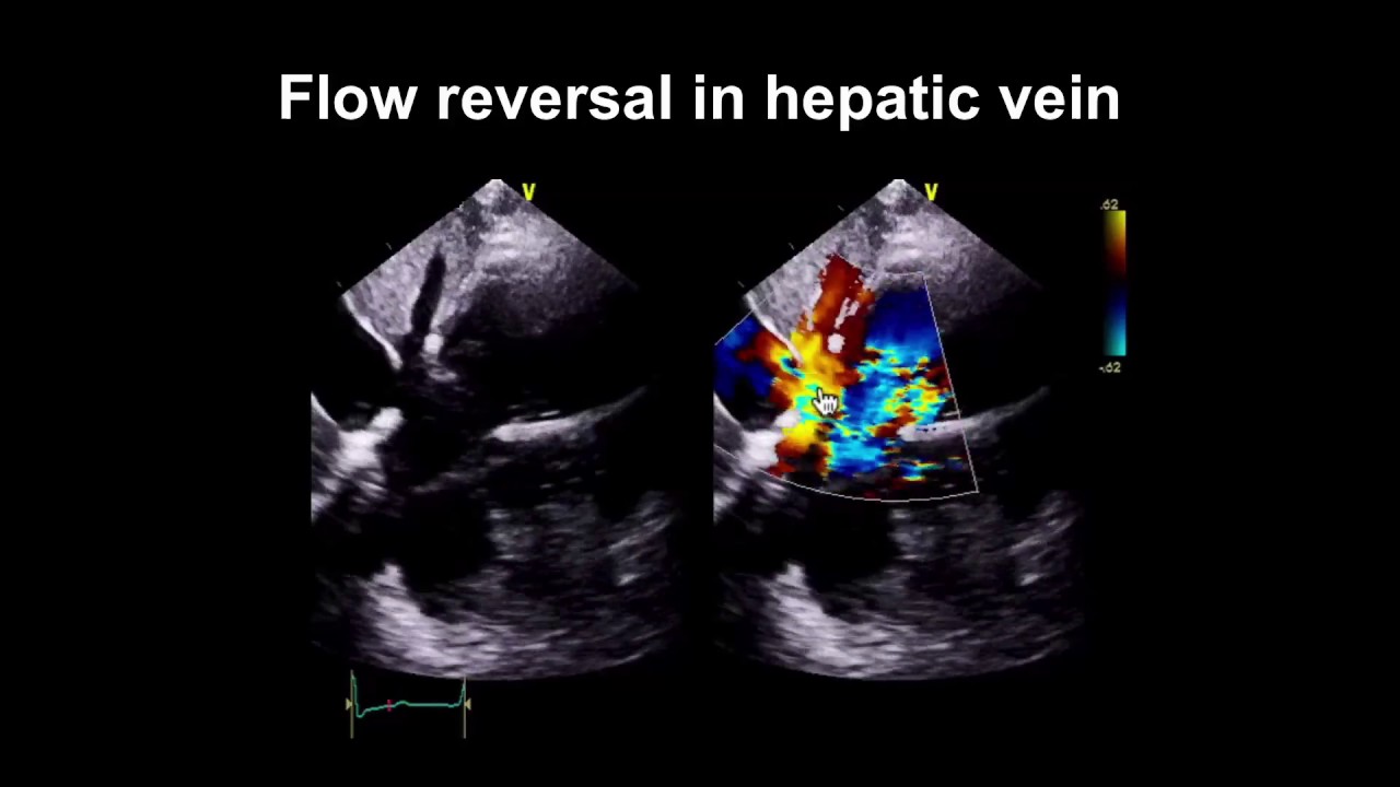 Echocardiography Essentials Spotting tricuspid and pulmonary valve