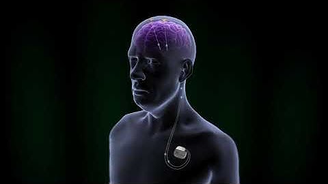 Deep Brain Stimulation    Understanding Targets