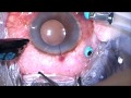 Macular hole surgery by drashish ahuja