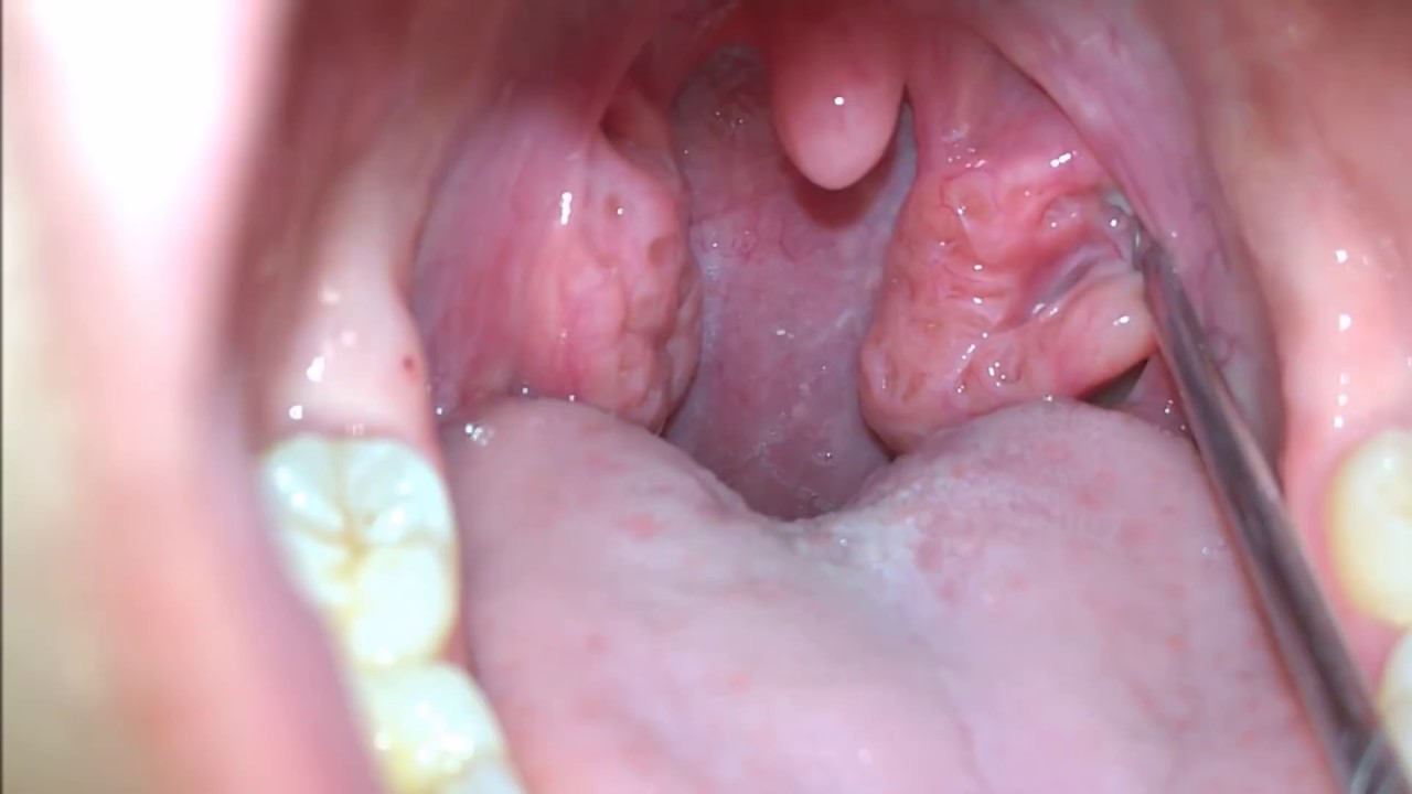Tonsil Stone Removal (Extended Cut) - YouTube