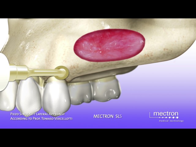 PIEZOSURGERY - ANIMATION - Sinus lift with lateral approach