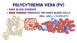 Understanding Polycythemia Vera (PV): Causes, Symptoms, and Treatment