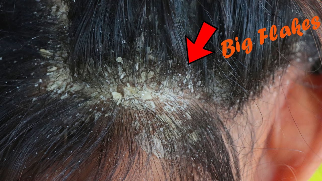 Removal Dandruff Flakes With Lice Comb Psoriasis Flakes Scalp Easy Scratching Dandruff Off Scalp