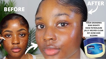 HOW VASELINE HELPED CLEAR MY ACNE AND EZCEMA FASTER!! | KAISERCOBY