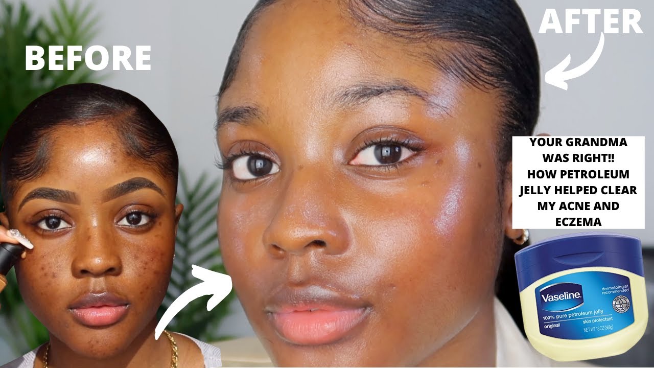 Vaseline Good For Your Face? | Simply Skin