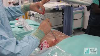 Pcnl Using Metallic Storz Alcan Dilators