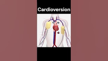 Cardioversion
