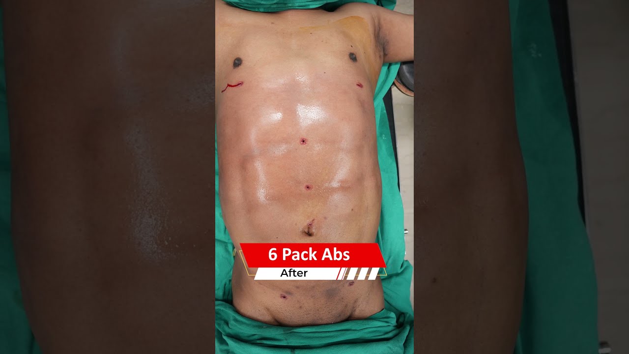 6 Pack Abs Surgery Six Result Liposuction Cost Shortvideo Shots