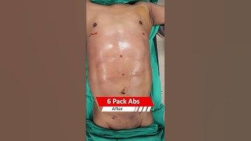 6 Pack Abs surgery | Six Pack Abs surgery Result | Liposuction cost #shortvideo #shots