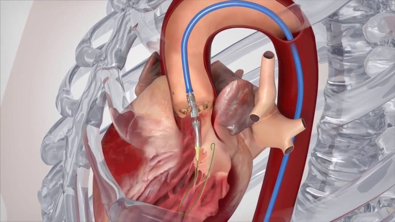 Factors Affecting Recovery From Heart Valve Surgery Youtube