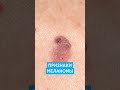 Меланома кожи 📌 симптомы, признаки, фото как выглядит рак кожи