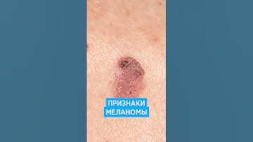 Меланома кожи 📌 симптомы, признаки, фото как выглядит рак кожи