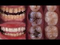 Bu Tarif Kirli Sarı Dişlerinizi Sadece 2 Dakikada İnci Gibi Parlatacak   Evde Doğal Diş Beyazlatma