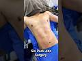 Immediate result of six pack abs surgery  complete body transformation at divine ytshorts