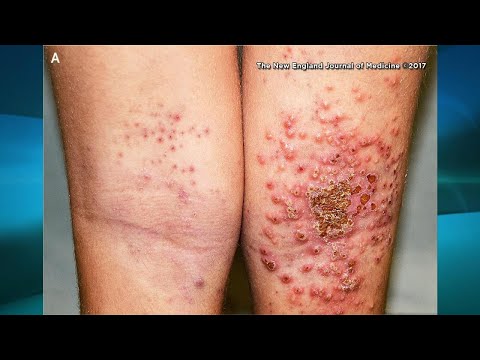 What You Need to Know if You Have Eczema