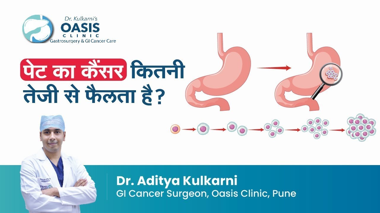पेट का कैंसर कितनी तेजी से फैलता है? | How quickly does stomach cancer ...
