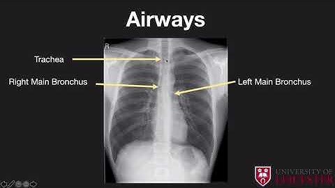 Introduction to chest x-rays