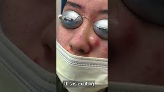 pimple popping 2023 new, blackheads on nose, pimple popping tiktok 34533