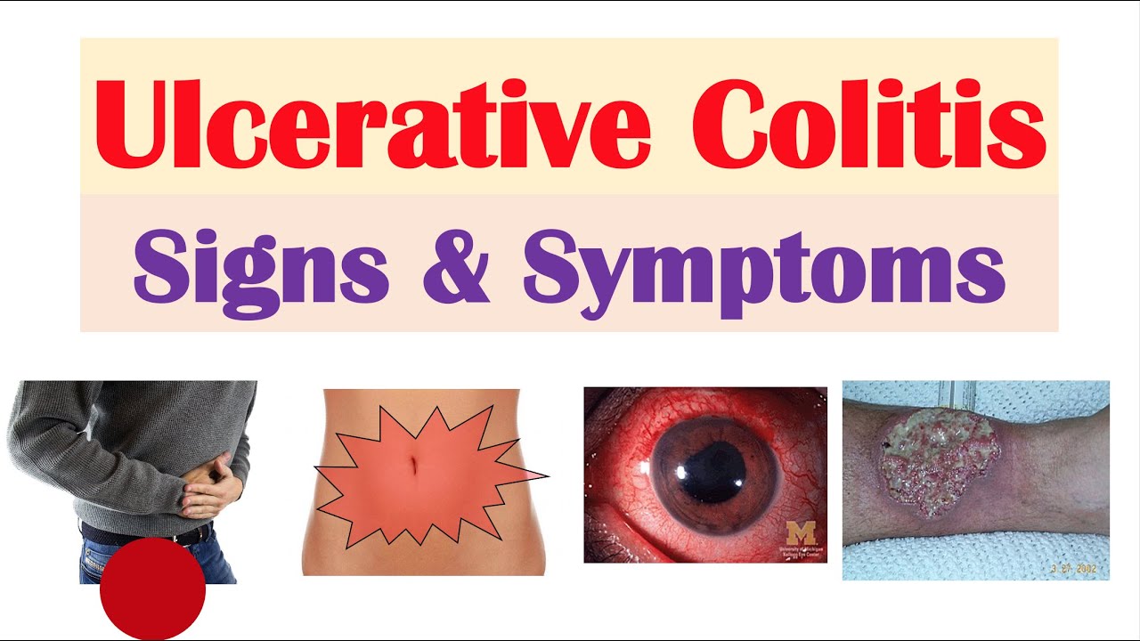 Ulcerative Colitis Signs and Symptoms (& Why They Occur), and Complications  