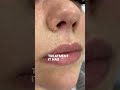 Milia Removal Treatment Before & After #advancedelectrolysis #skincare #miliaremoval