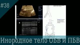 УЗИ вен. Инородное тело в глубокой вене на уровне бедра.