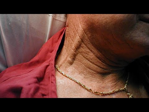 Bizarre Neck Veins? Must See