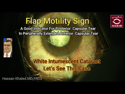 Flap Motility Sign In Peripheral Extension Of Anterior Capsularhexis In Intumescent Cataract