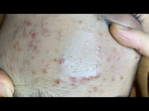 Teenage Girl With Puberty Acne Problem | Bạn Gái Gặp Vấn Đề Mụn Tuổi Dậy Thì - SacDepSpa#142