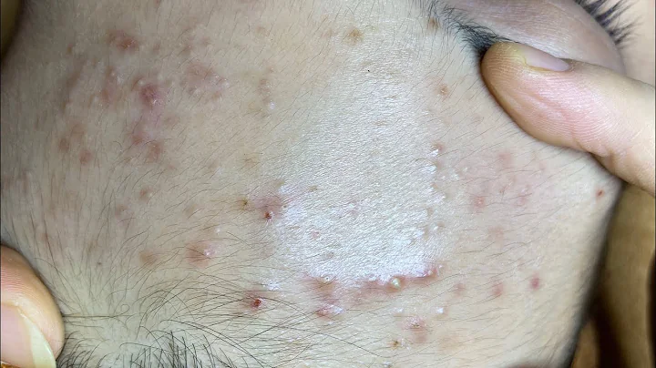 Teenage Girl With Puberty Acne Problem | Bạn Gái Gặp Vấn Đề Mụn Tuổi Dậy Thì - SacDepSpa#142 - DayDayNews