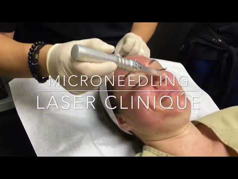 Microneedling with PRP