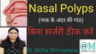 Nasal polyps Homeopathic Medicine।Nasal polyps Treatment without Surgery।Nose block।नाक की गांठ इलाज