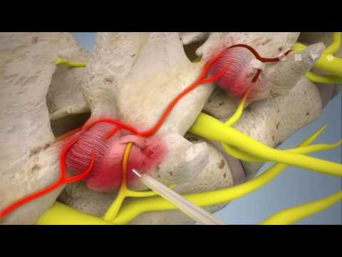 Video: Varför utförs endoskopier?