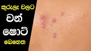 කුරුලෑ වලට වඩාත් සාර්ථක අත් බෙහෙත | Kurule Walata Sarala Behetha