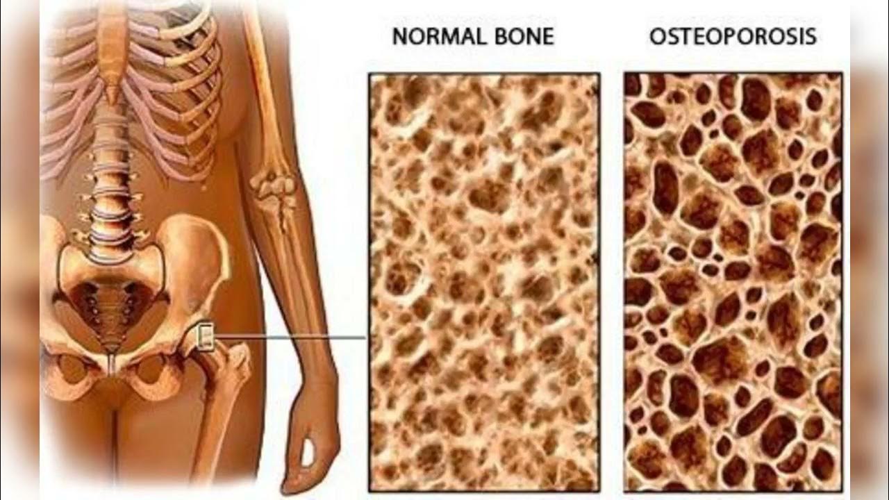 Brittle bones. Остеопороз патологическая анатомия. Остеопороз кость. Люди с остеопорозом.