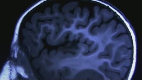 Study finds exercise can protect against Alzheimer