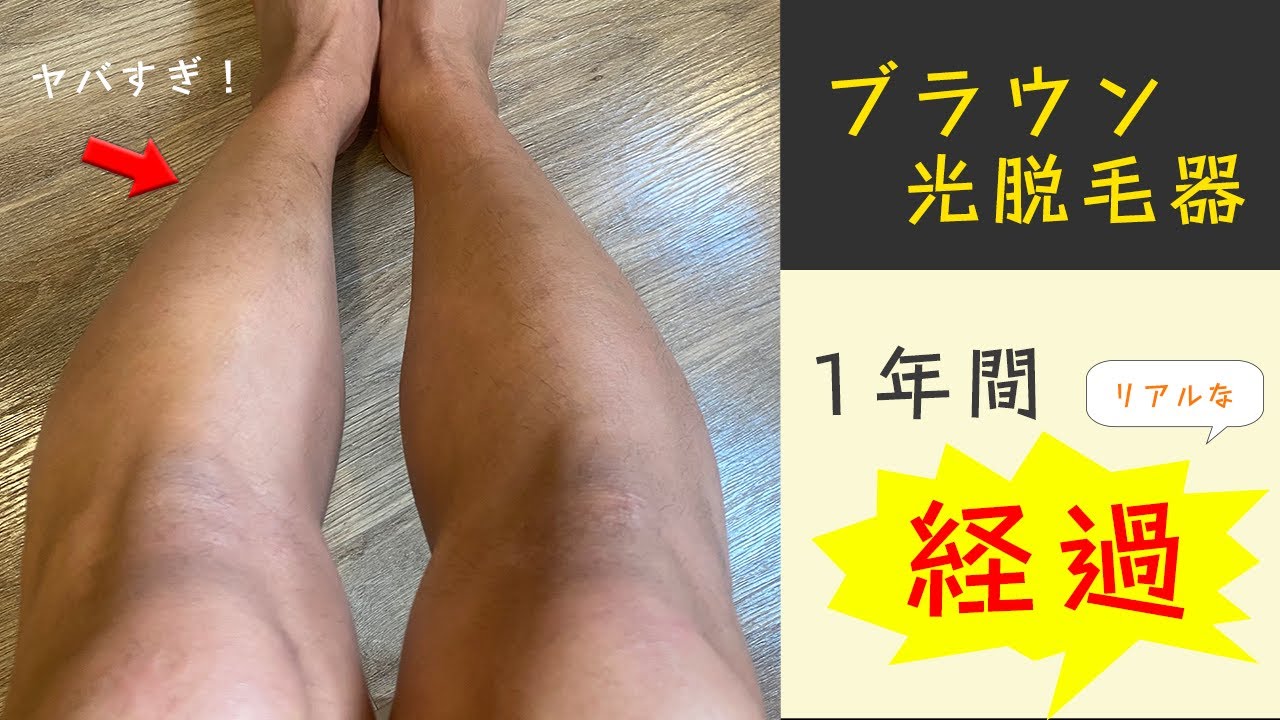 【1年間】ブラウン光脱毛器を男の腕毛・すね毛に使ってみたリアルな経過。#家庭用脱毛器の本性 - YouTube