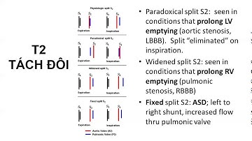 Cơ chế tiếng tim T1, T2 tách đôi (P.3)
